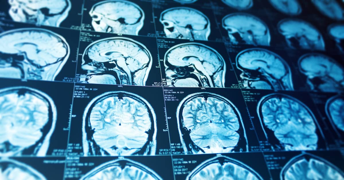 Closed-Head Injury Signs and Symptoms After a Car Accident